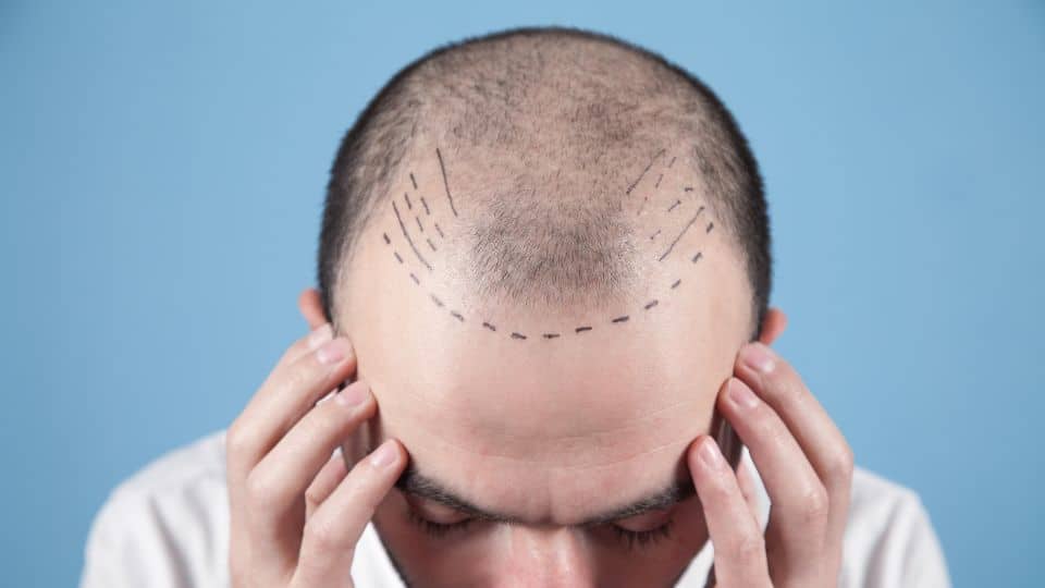 האם אפשר לעצור את ההתקרחות?